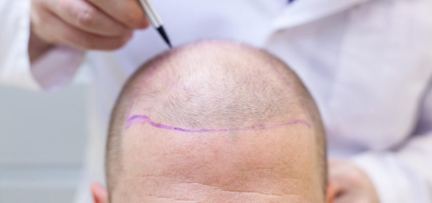 preparation-for-hair-transplant-surgery1